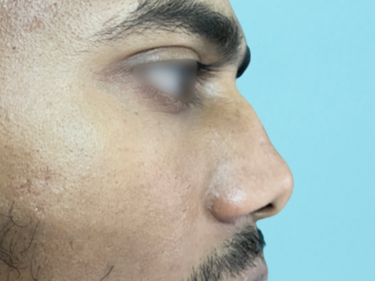Before - Crooked Nose